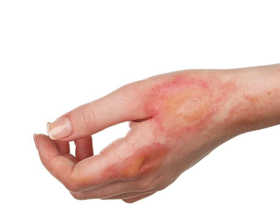 Hội chứng Lyell: Nguyên nhân, biểu hiện, cách điều trị và phòng bệnh