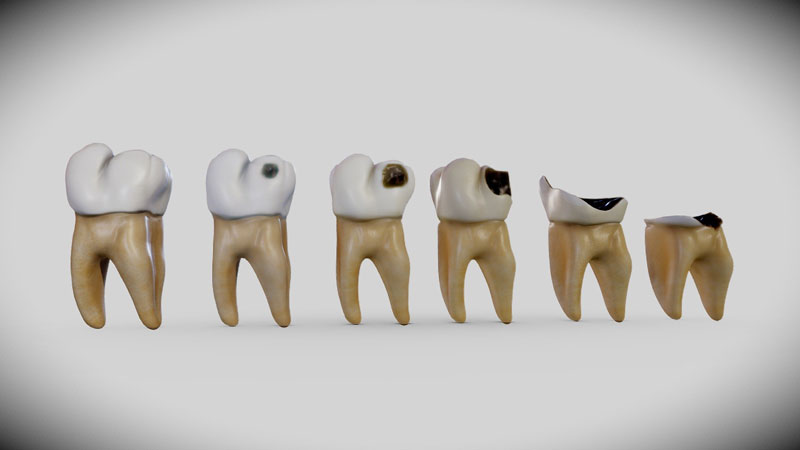 6 biểu hiện của sâu răng cần lưu ý