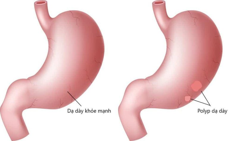 Polyp dạ dày có nguy hiểm không?