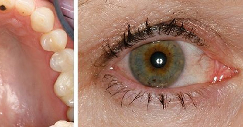 Câu hỏi thường gặp liên quan đến hội chứng Sjogren