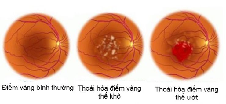 Phát hiện sớm bệnh lý đáy mắt để tránh nguy cơ mù lòa