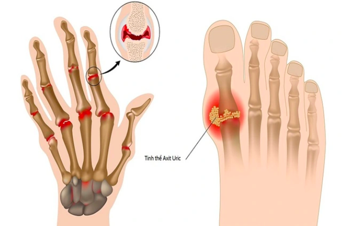 5 cách đào thải axit uric nhanh khỏi cơ thể cần biết