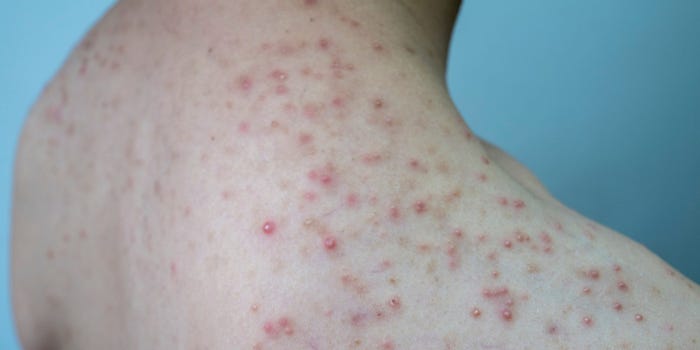 Những lưu ý khi tập thể dục ở người bị viêm nang lông