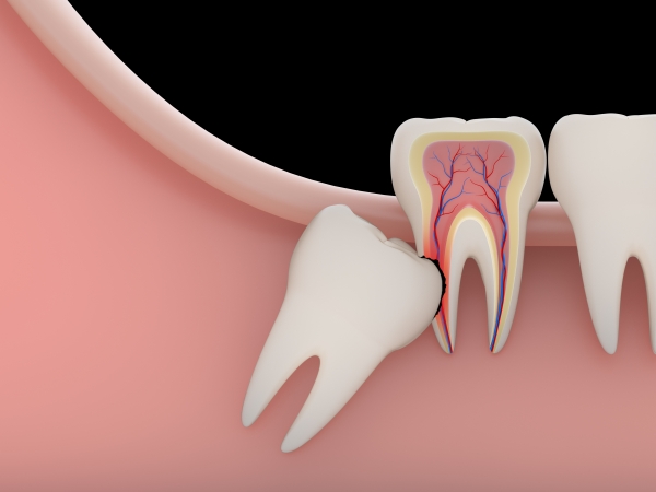Răng khôn mọc lệch, ngầm gây biến chứng gì?