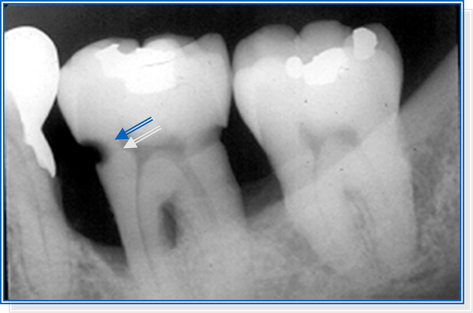 Các phương pháp điều trị sâu răng