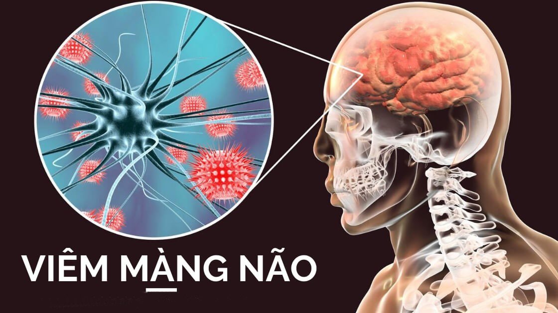 Bài tập nào tốt cho người viêm não Nhật Bản?