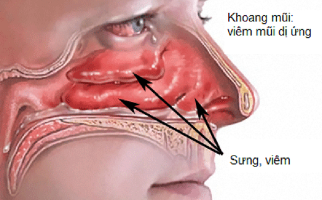 Hai vị thuốc chữa viêm mũi dị ứng tái phát khi gặp lạnh